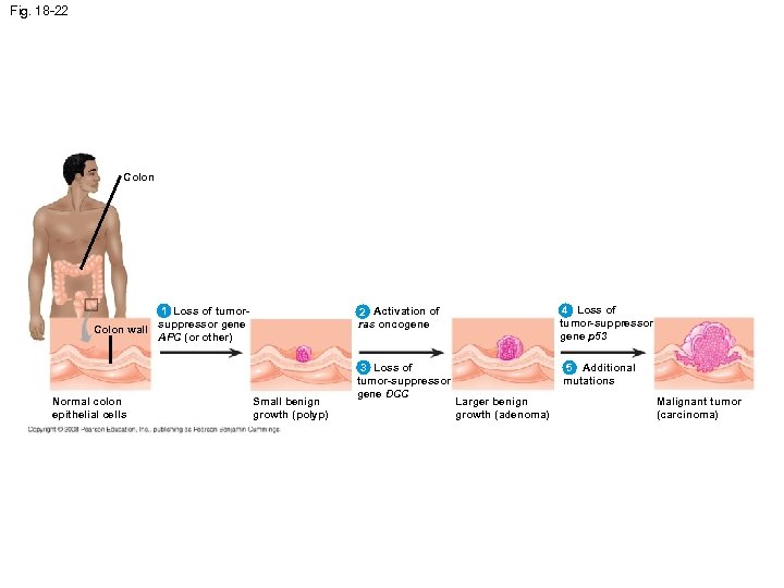 Fig. 18 -22 Colon EFFECTS OF MUTATIONS 2 Activation of ras oncogene 1 Loss