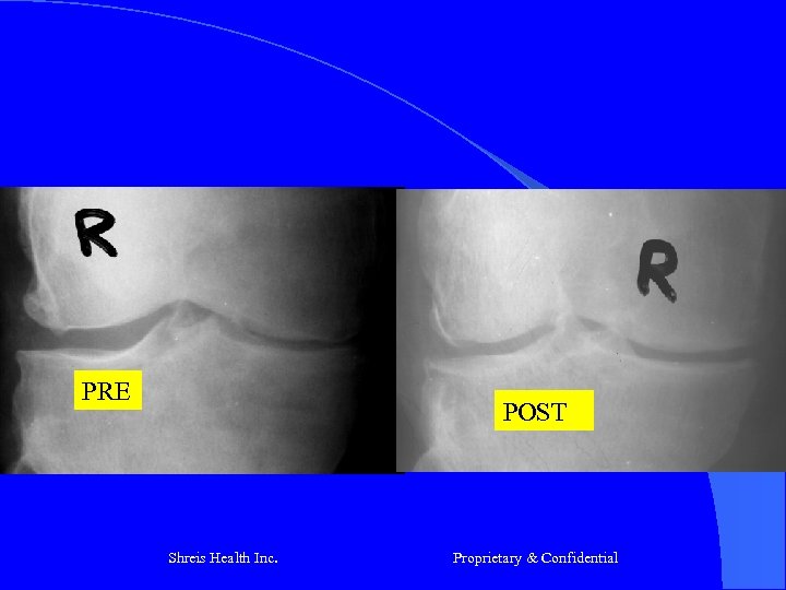 PRE POST Shreis Health Inc. Proprietary & Confidential 