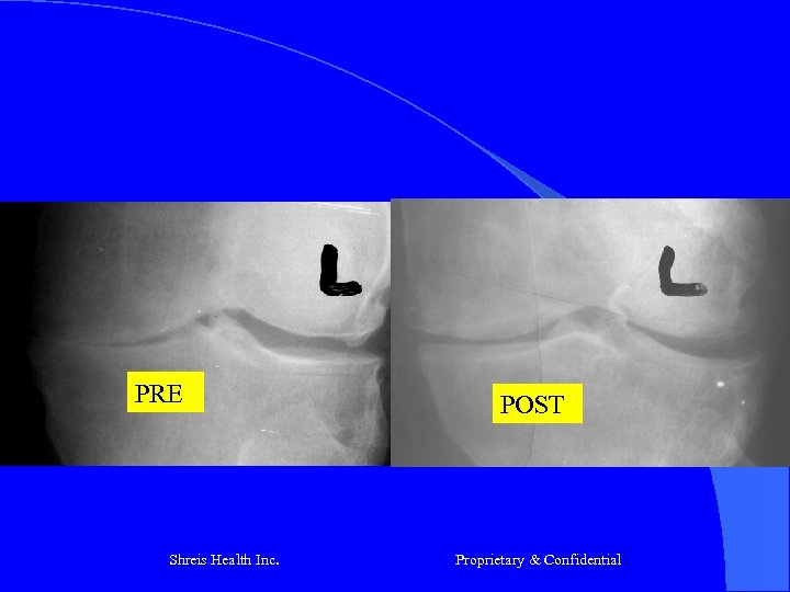 PRE Shreis Health Inc. POST Proprietary & Confidential 