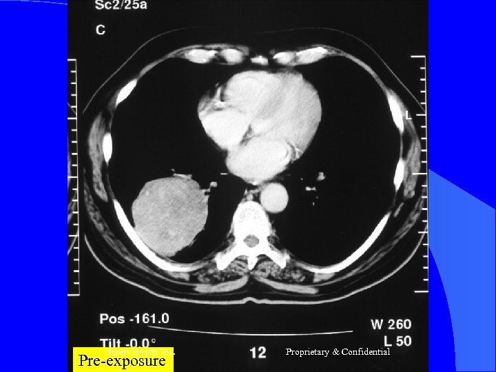 Shreis Health Inc. Pre-exposure Proprietary & Confidential 