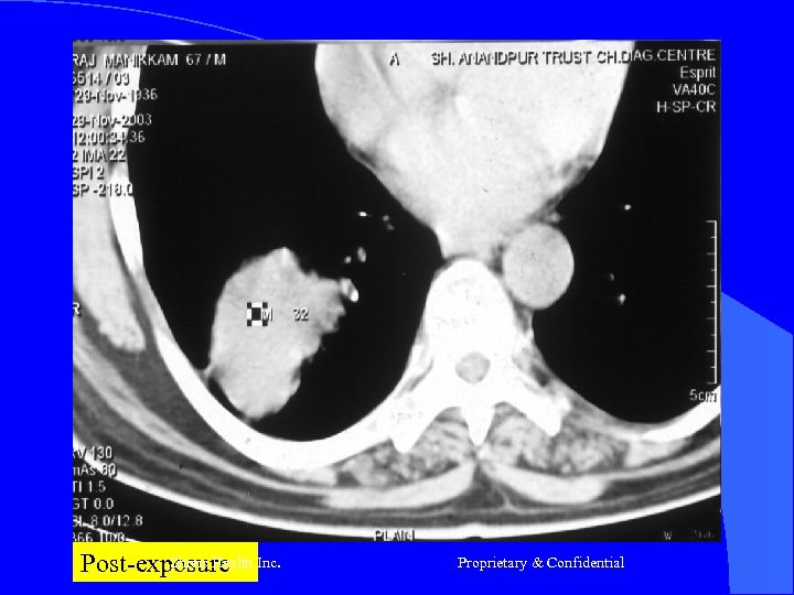 Shreis Health Post-exposure Inc. Proprietary & Confidential 