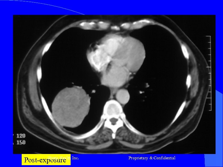 Shreis Health Post-exposure Inc. Proprietary & Confidential 