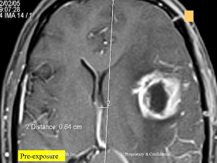 Shreis Pre-exposure. Health Inc. Proprietary & Confidential 