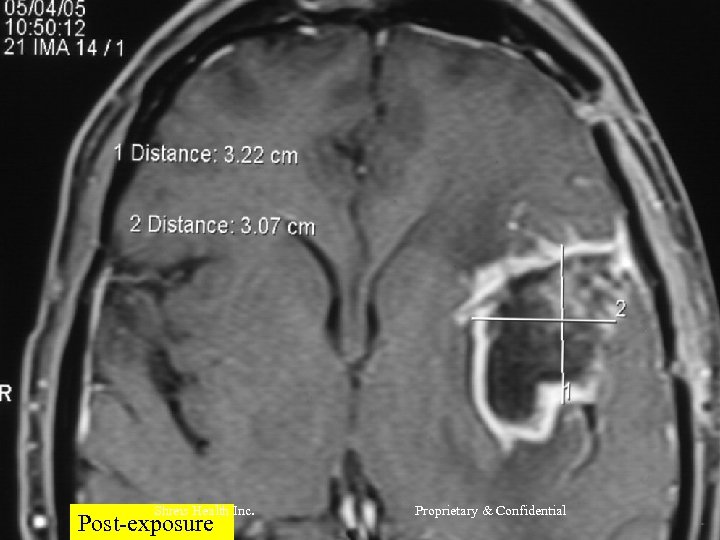 Shreis Health Inc. Post-exposure Proprietary & Confidential 
