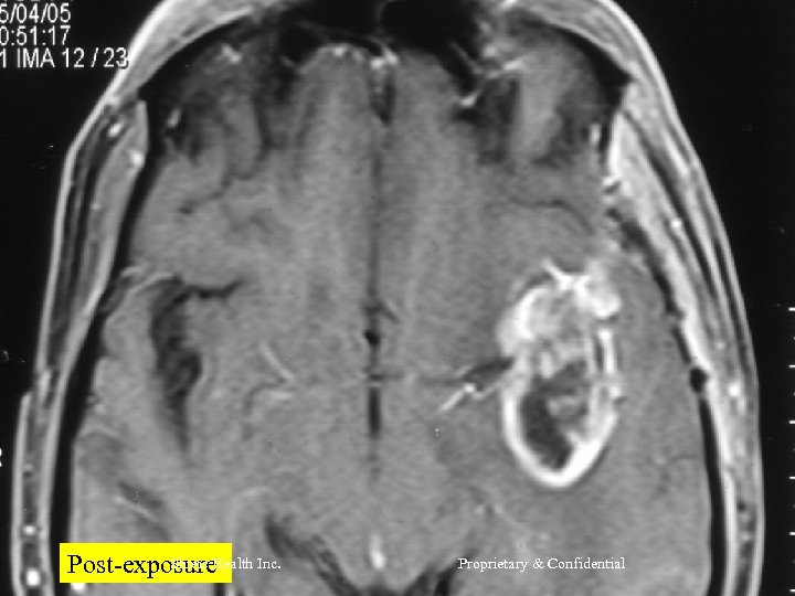 Shreis Health Post-exposure Inc. Proprietary & Confidential 