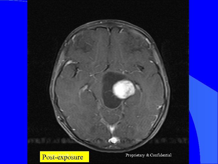 Shreis Health Inc. Post-exposure Proprietary & Confidential 