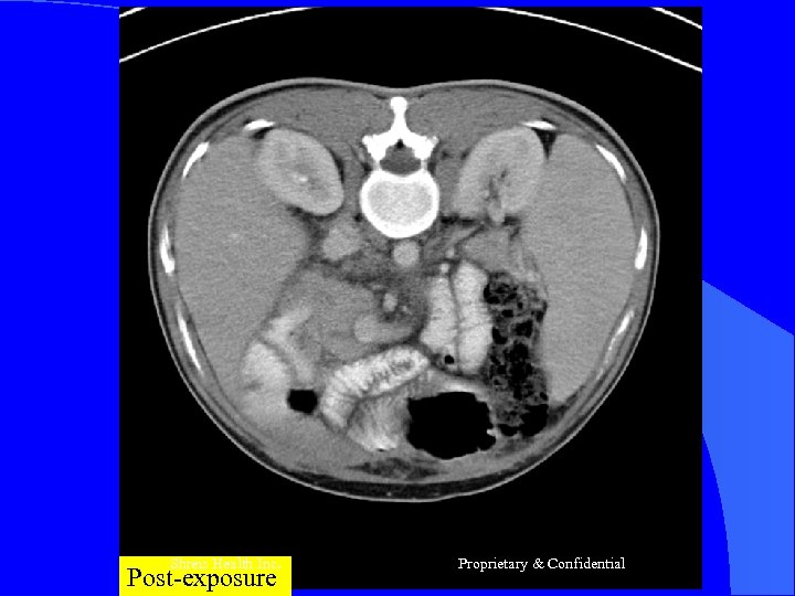 Shreis Health Inc. Post-exposure Proprietary & Confidential 