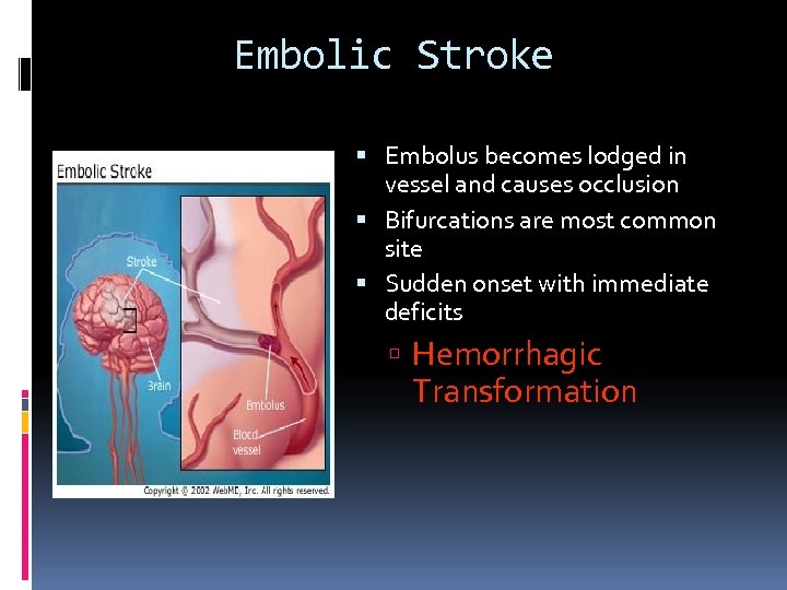 Embolic Stroke Embolus becomes lodged in vessel and causes occlusion Bifurcations are most common