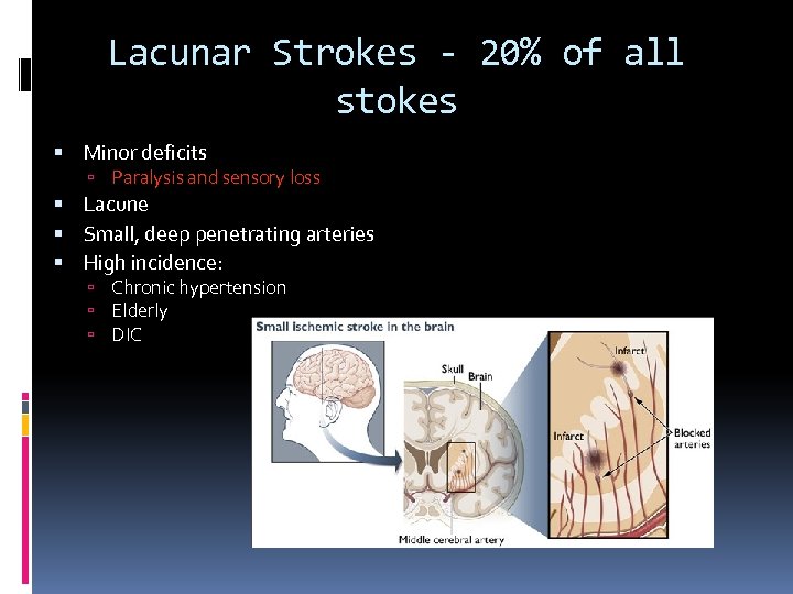 Lacunar Strokes - 20% of all stokes Minor deficits Paralysis and sensory loss Lacune