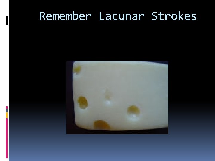 Remember Lacunar Strokes 