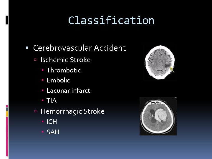 Classification Cerebrovascular Accident Ischemic Stroke Thrombotic Embolic Lacunar infarct TIA Hemorrhagic Stroke ICH SAH