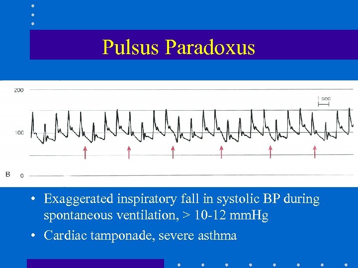 Pulsus Paradoxus • Exaggerated inspiratory fall in systolic BP during spontaneous ventilation, > 10