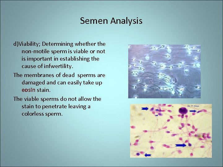 Semen Analysis d)Viability; Determining whether the non-motile sperm is viable or not is important