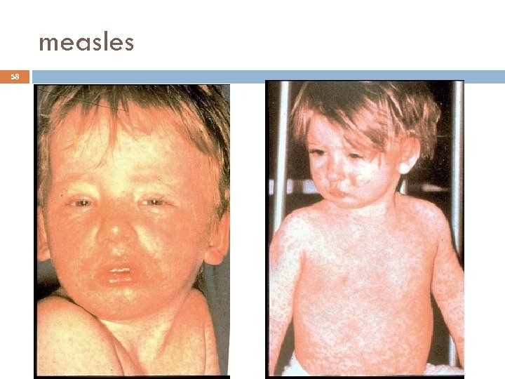 measles 58 