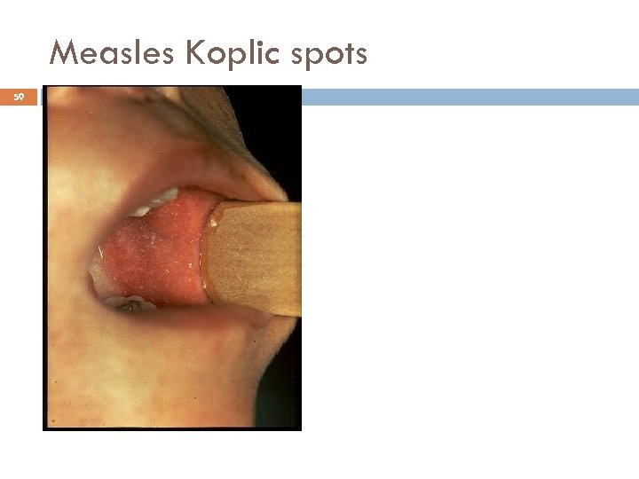 Measles Koplic spots 59 