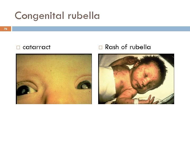 Congenital rubella 76 catarract Rash of rubella 
