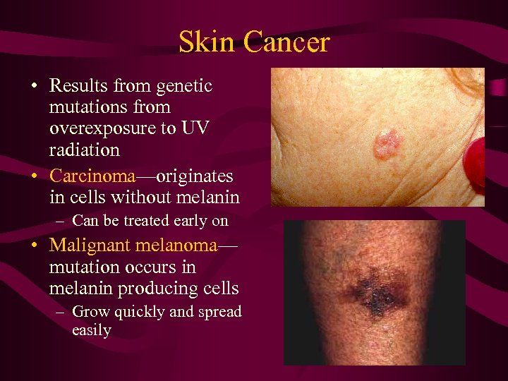 Skin Cancer • Results from genetic mutations from overexposure to UV radiation • Carcinoma—originates