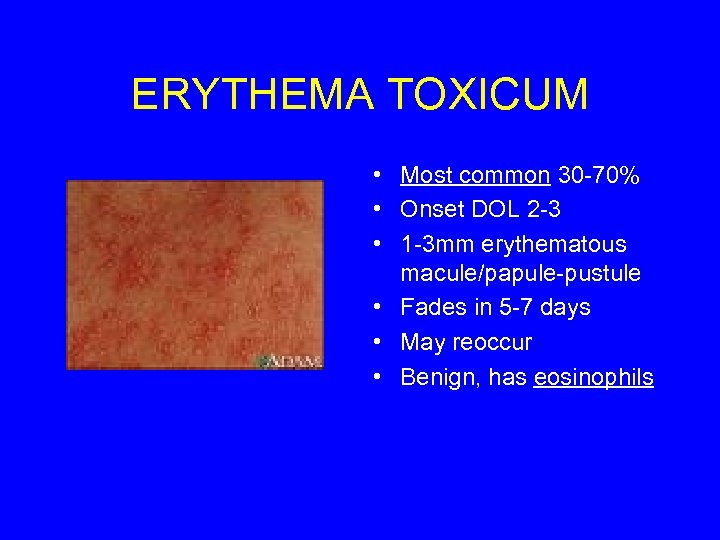 ERYTHEMA TOXICUM • Most common 30 -70% • Onset DOL 2 -3 • 1