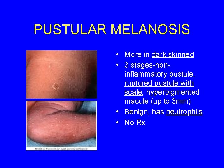 PUSTULAR MELANOSIS • More in dark skinned • 3 stages-noninflammatory pustule, ruptured pustule with