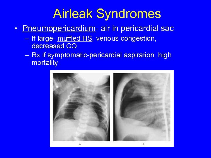 Airleak Syndromes • Pneumopericardium- air in pericardial sac – If large- muffled HS, venous