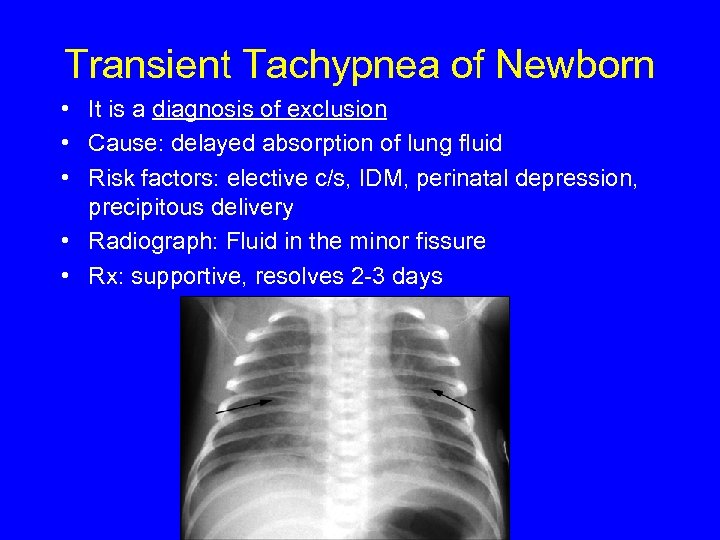 Transient Tachypnea of Newborn • It is a diagnosis of exclusion • Cause: delayed