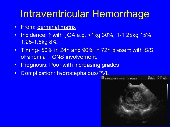 Intraventricular Hemorrhage • From: germinal matrix • Incidence: ↑ with ↓GA e. g. <1