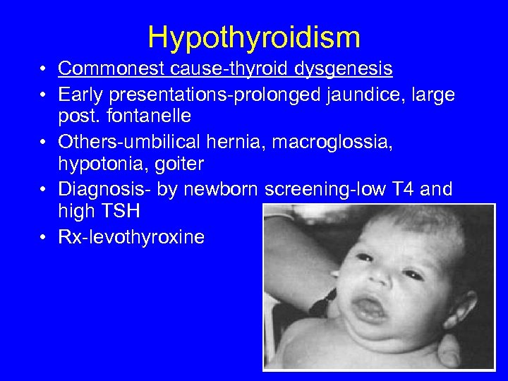 Hypothyroidism • Commonest cause-thyroid dysgenesis • Early presentations-prolonged jaundice, large post. fontanelle • Others-umbilical