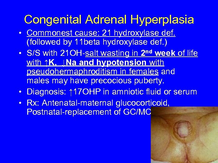 Congenital Adrenal Hyperplasia • Commonest cause: 21 hydroxylase def. (followed by 11 beta hydroxylase