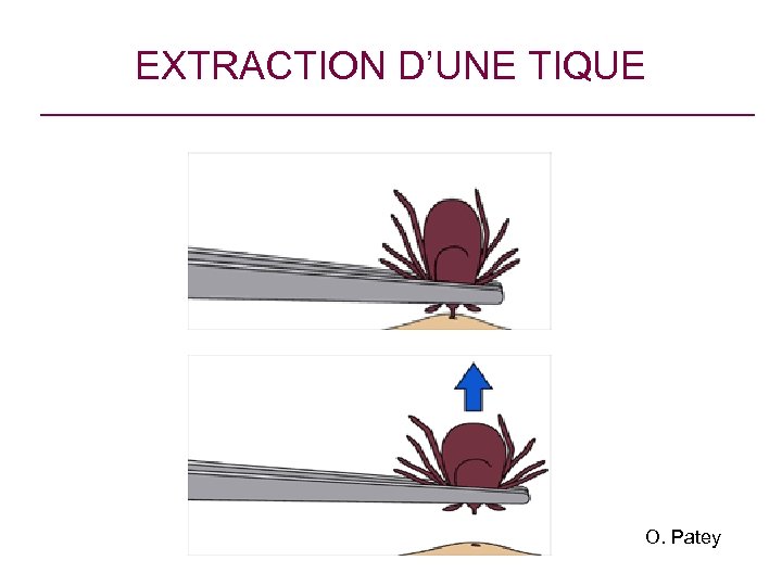 EXTRACTION D’UNE TIQUE O. Patey 