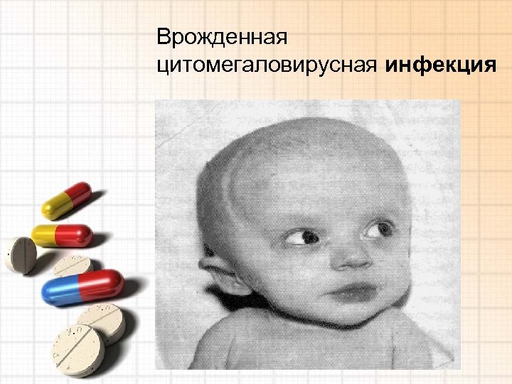 Врожденная цитомегаловирусная инфекция 
