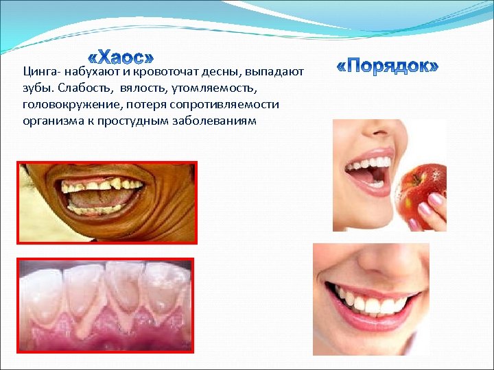 Цинга- набухают и кровоточат десны, выпадают зубы. Слабость, вялость, утомляемость, головокружение, потеря сопротивляемости организма