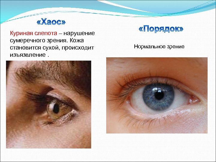 Куриная слепота – нарушение сумеречного зрения. Кожа становится сухой, происходит изъязвление. Нормальное зрение 