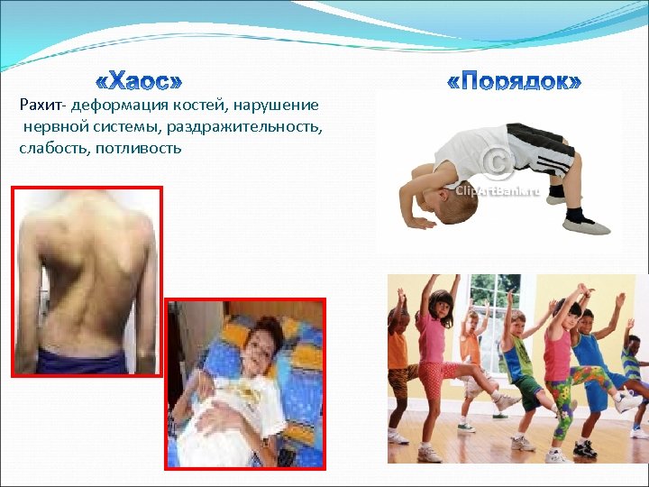 Рахит- деформация костей, нарушение нервной системы, раздражительность, слабость, потливость 