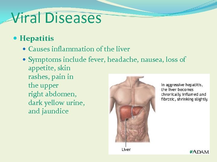 Viral Diseases Hepatitis Causes inflammation of the liver Symptoms include fever, headache, nausea, loss
