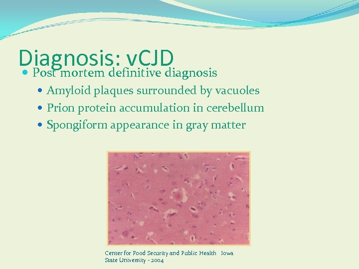 Diagnosis: v. CJD Post mortem definitive diagnosis Amyloid plaques surrounded by vacuoles Prion protein