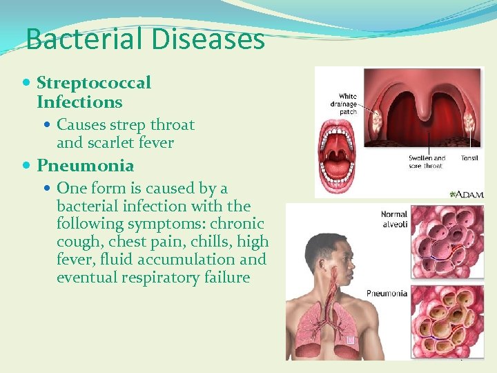 Bacterial Diseases Streptococcal Infections Causes strep throat and scarlet fever Pneumonia One form is