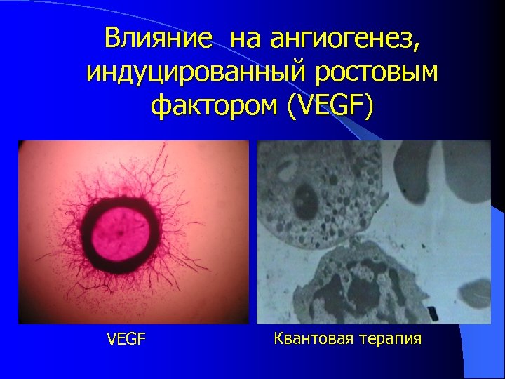 Влияние на ангиогенез, индуцированный ростовым фактором (VEGF) VEGF Квантовая терапия 