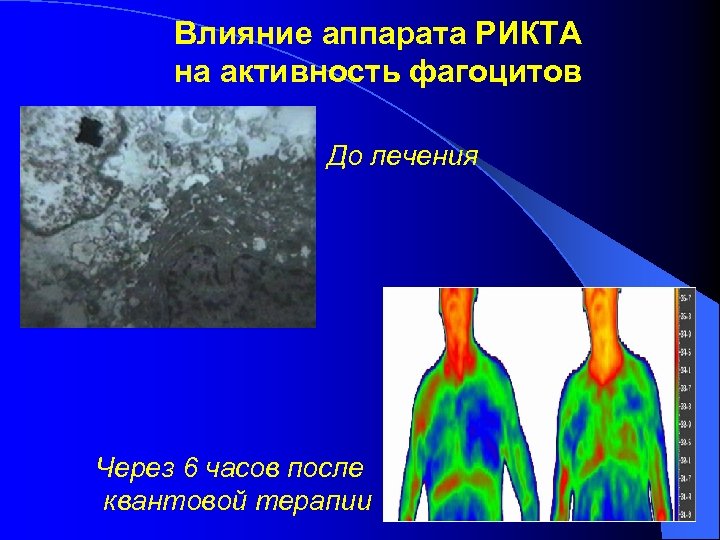 Влияние аппарата РИКТА на активность фагоцитов До лечения Через 6 часов после квантовой терапии