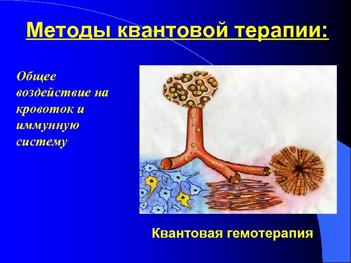 Методы квантовой терапии: Общее воздействие на кровоток и иммунную систему Квантовая гемотерапия 