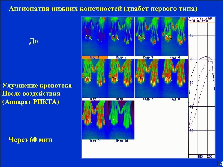 Ангиопатия нижних конечностей (диабет первого типа) До Улучшение кровотока После воздействия (Аппарат РИКТА) Через