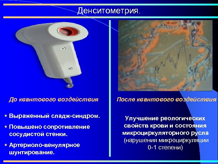 Денситометрия. До квантового воздействия После квантового воздействия § Выраженный сладж-синдром. Улучшение реологических свойств крови