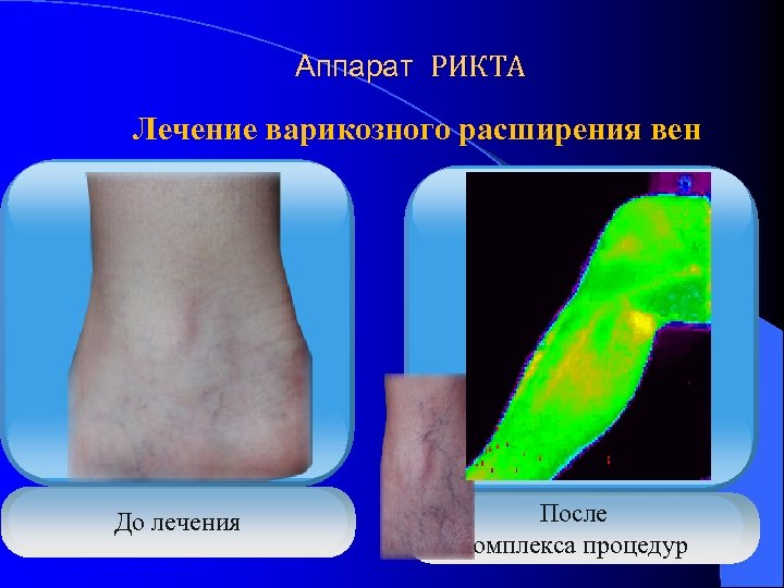 Аппарат РИКТА Лечение варикозного расширения вен До лечения После комплекса процедур 