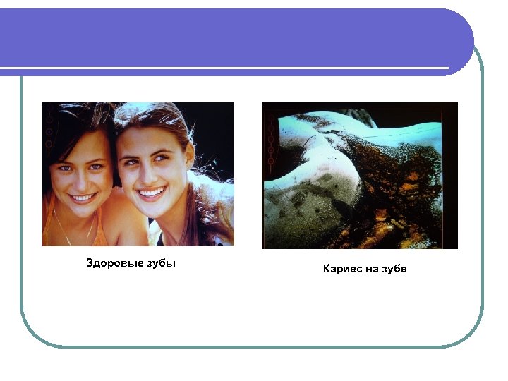 Здоровые зубы Кариес на зубе 