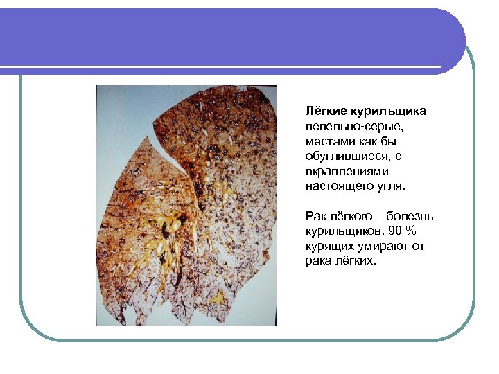 Лёгкие курильщика пепельно-серые, местами как бы обуглившиеся, с вкраплениями настоящего угля. Рак лёгкого –