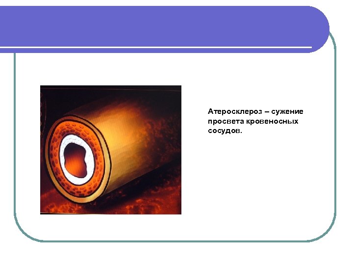 Атеросклероз – сужение просвета кровеносных сосудов. 