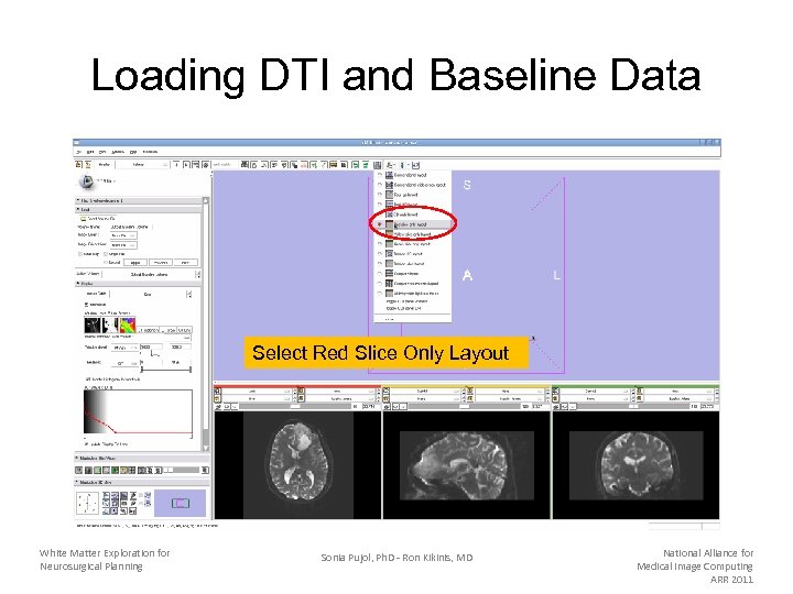Loading DTI and Baseline Data Select Red Slice Only Layout White Matter Exploration for