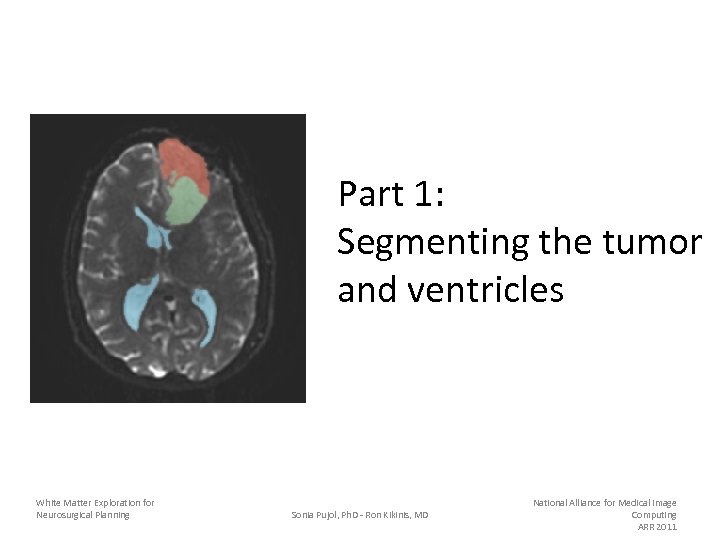 Part 1: Segmenting the tumor and ventricles White Matter Exploration for Neurosurgical Planning Sonia