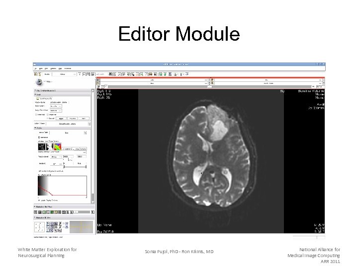 Editor Module White Matter Exploration for Neurosurgical Planning Sonia Pujol, Ph. D - Ron