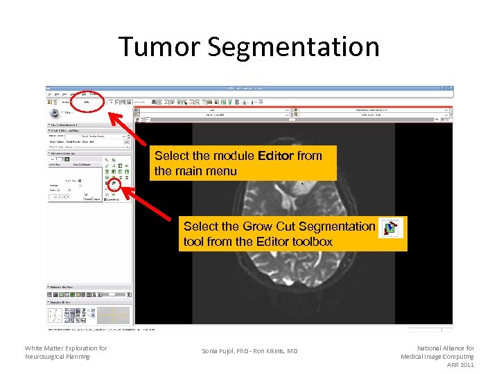 Tumor Segmentation Select the module Editor from the main menu Select the Grow Cut