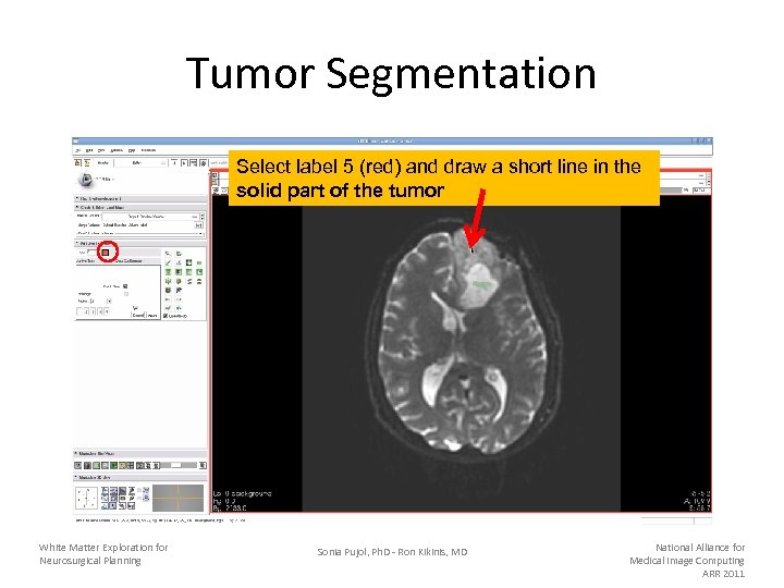 Tumor Segmentation Select label 5 (red) and draw a short line in the solid